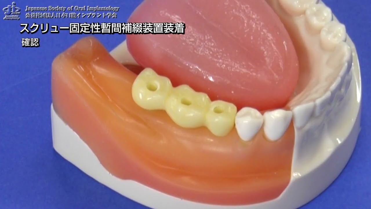 動画コンテンツ（インプラント）｜株式会社ニッシン｜歯科模型・歯科
