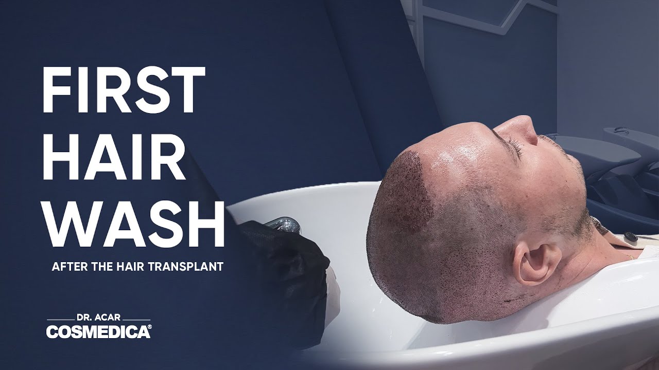 First Hair Wash After the Hair Transplant YouTube