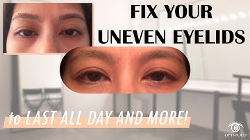 Treatable Cases 8 | Making double eyelids or fixing uneven eyelids with Optifold
