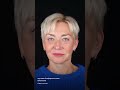 Омоложение взгляда с помощью блефаропластики