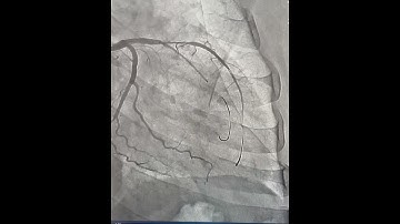 LAD-D1 bifurcation using MINI CRUSH technique