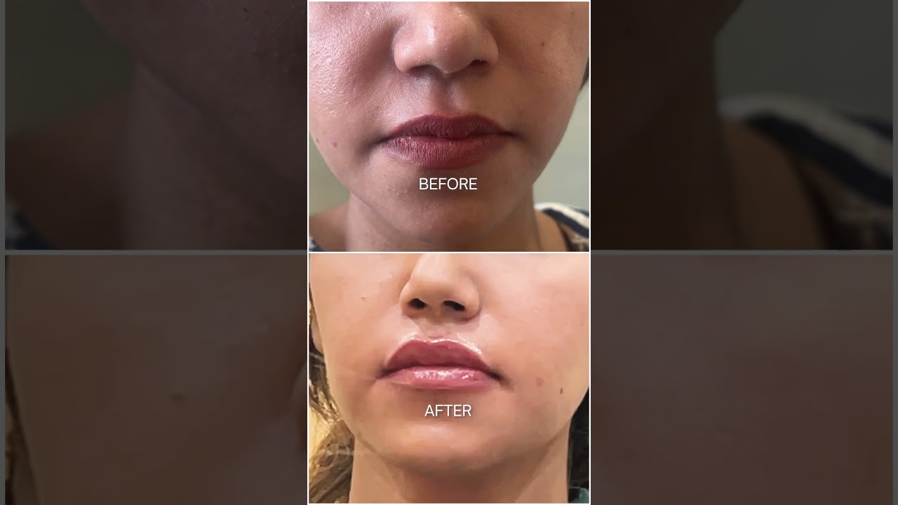Video poster for Lip Fillers in Gurgaon 💋 Natural-Looking Lip Enhancement by Dr. Akanksha Agarwal