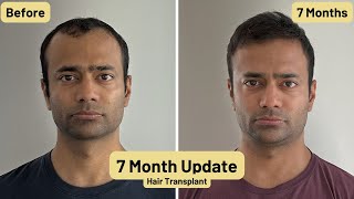 7 Month Update for Hair Transplant | 5200 grafts from Istanbul Turkey