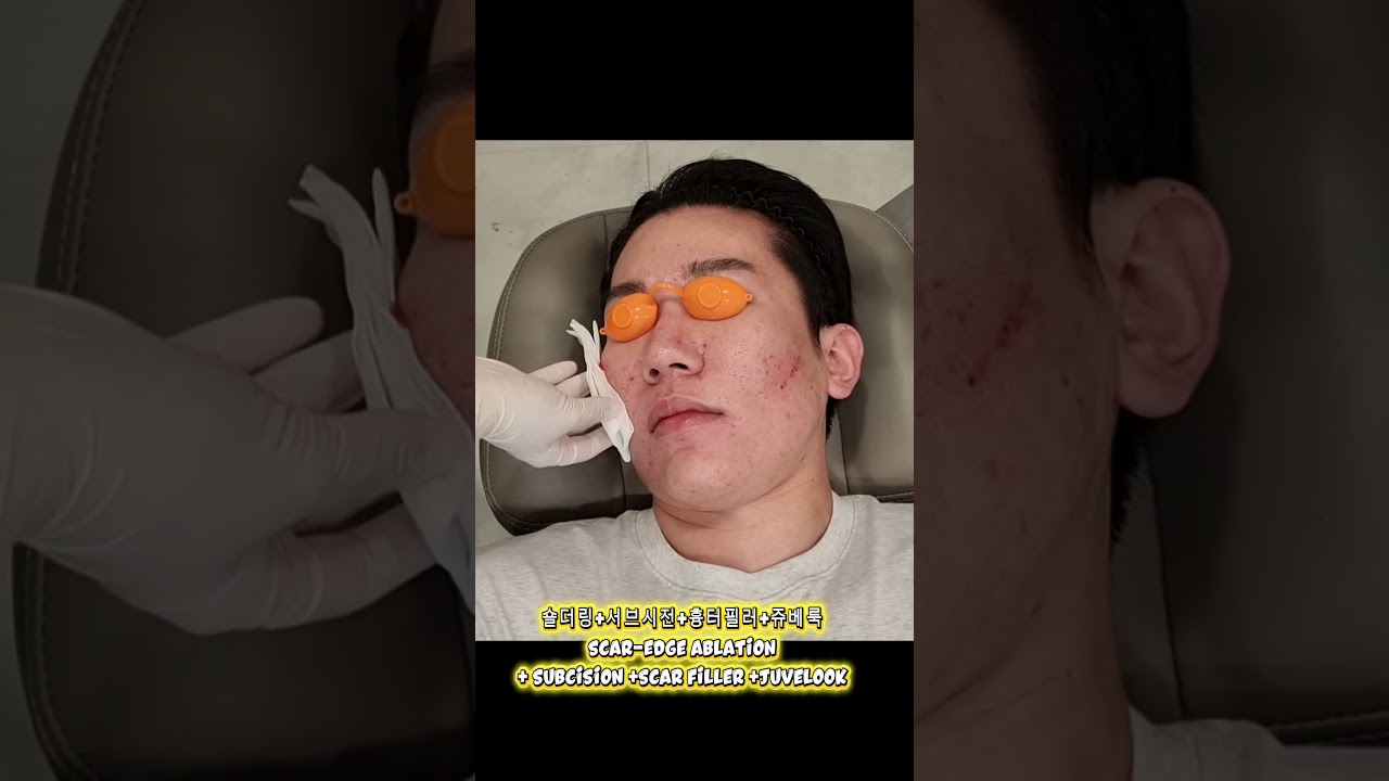#acne #acnescars #여드름흉터#스킨케어