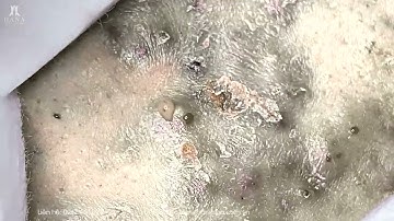 Big Cystic Acne Blackheads Extraction Blackheads & Milia, Whiteheads Removal Pimple Popping
