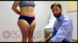 THIGH LIFT- Award Winning " Best of Nashville" Plastic Surgeon Dr. Chad Robbins