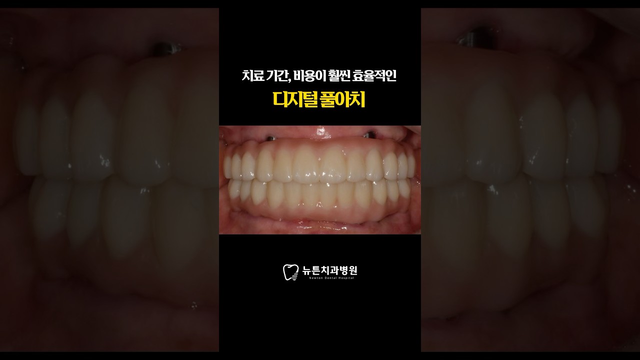 [부산임플란트] 치료 기간, 비용이 훨씬 효율적인 " 디지털 풀아치 " 