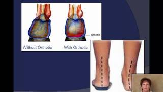Plantar Fasciitis explained by a Podiatrist