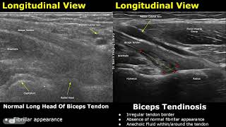 Elbow Ultrasound Normal Vs Abnormal Images | Muscles, Tendons, Ligaments and Nerves MSK USG