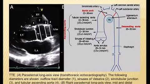SIÊU ÂM TIM BÌNH THƯỜNG Ở NGƯỜI LỚN - PGS. TS Trần Kim Trang
