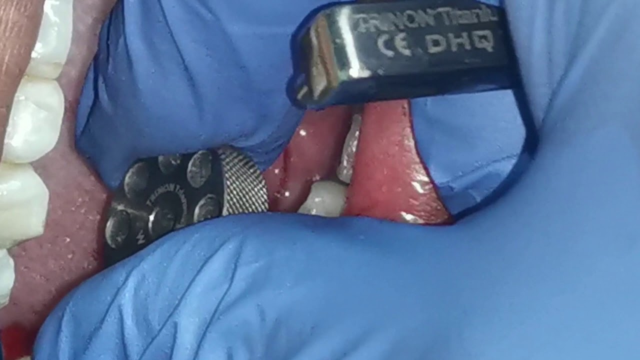 Trinon (German) Single Stage Implant Placement YouTube