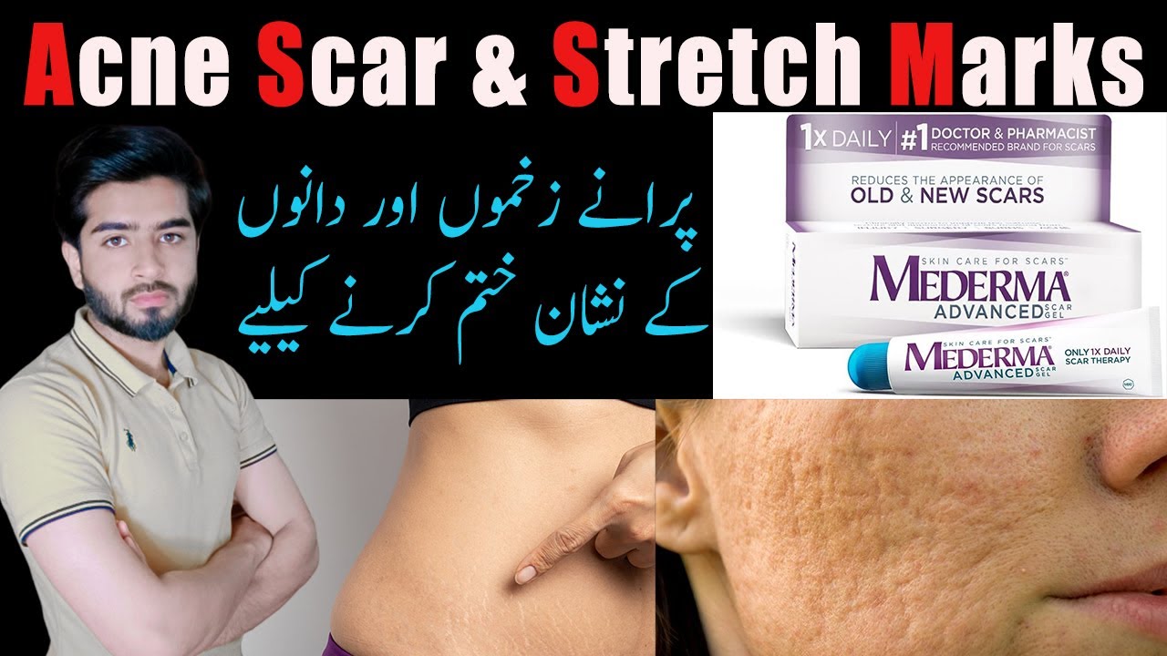 Best Gel For Acne Scar & Stretch Marks New & Old Scars Treatment