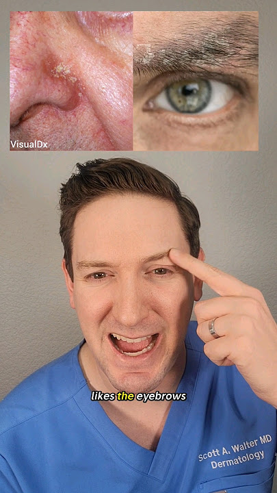 Dokter kulit menjelaskan Dermatitis Seboroik: Apa itu? Bagaimana cara mengobatinya? #dermatitisseboroik #derm