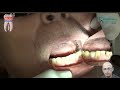 Como restaurar o dente com o esmalte quebradiço e mutilado . Dr Antônio Sérgio F Freitas