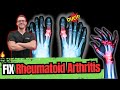 Rheumatoid Arthritis [Symptoms, Early Signs, Stages & BEST Treatment]