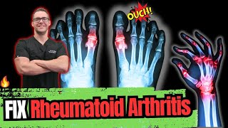 Rheumatoid Arthritis [Symptoms, Early Signs, Stages & BEST Treatment] screenshot 3