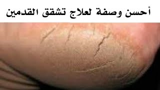 علاج نهائي لتشقق القدمين ، علاج طبيعي مجرب