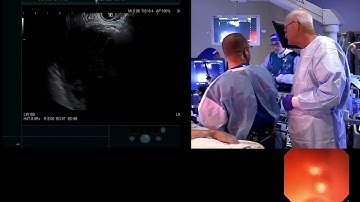 EUS guided cystgastrostomy by Dr. Mouen Khashab