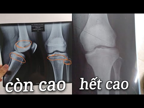 Cách nhận biết mình còn cao được không ? 2023 Mới