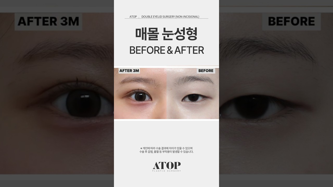 [A-TOP 整形外科] 手術前後比較，我的眼睛竟然變得這麼大了 #手術前後 #江南整形外科 #雙眼皮