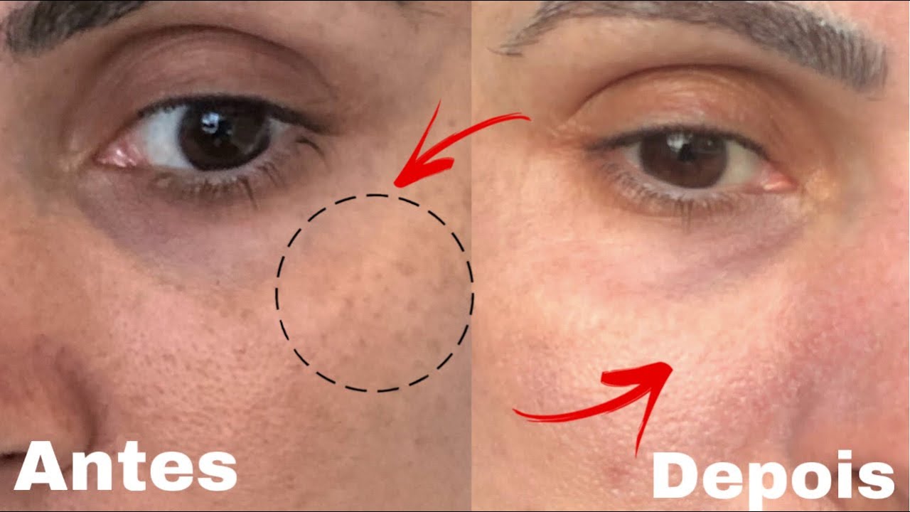 Melasma e Poros dilatados ! Tratamento com Laser lavieen / Nati Nahas