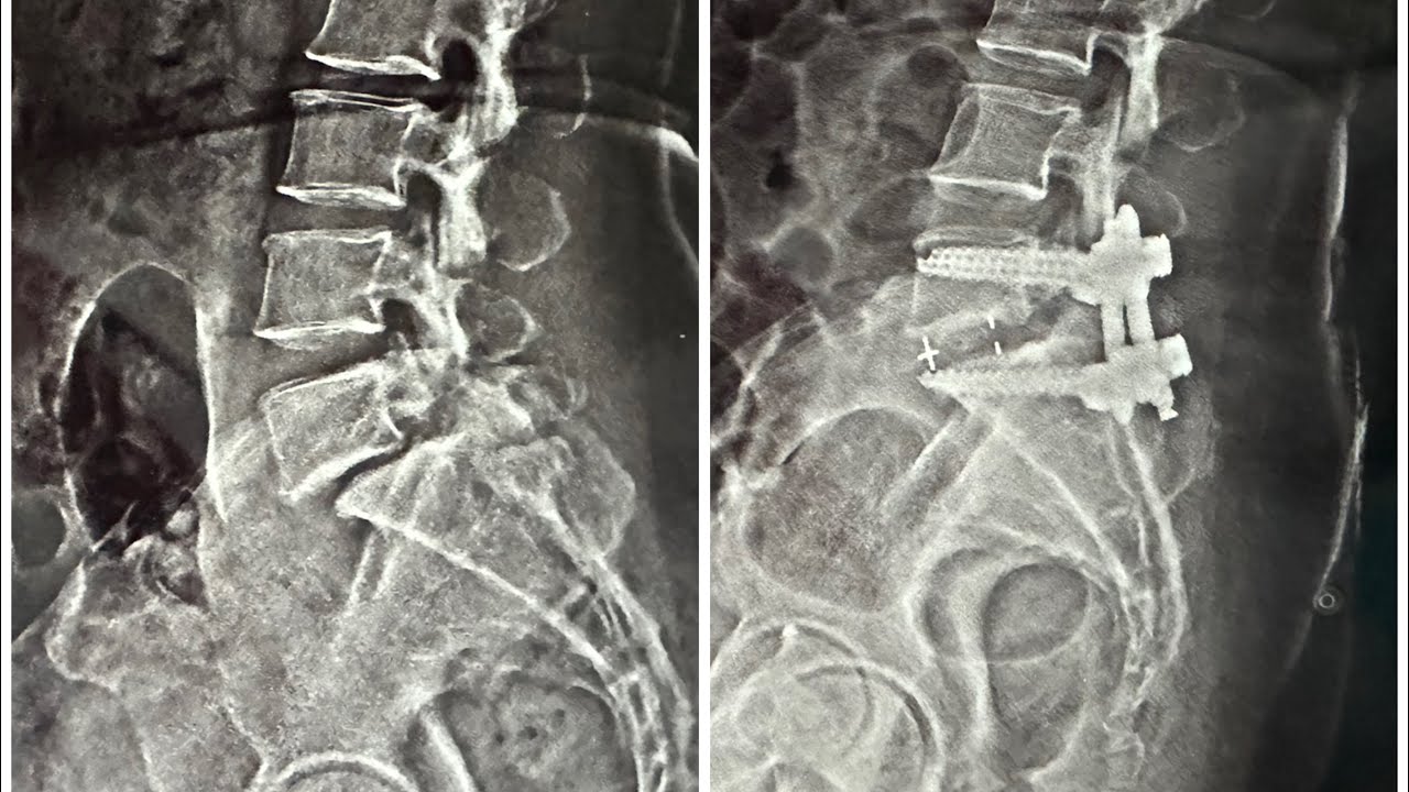 Lumbar Spondylolisthesis What Is The Treatment MIS TLIF lumbar-spondylolisthesis-what-is-the-treatment-mis-tlif