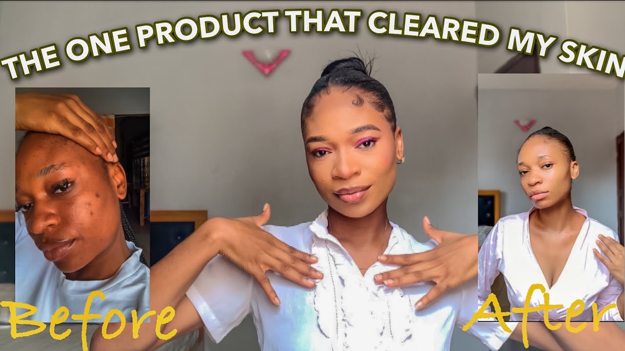 HOW I LIGHTEN MY SKIN AND GOT RID OF THE HYPERPIGMENTATION USING ONE ...
