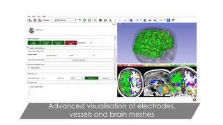 Epilepsy Surgical Treatment Automated Planning StereoElectroEncephaloGraphy SEEG