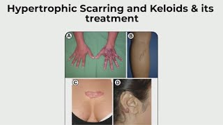 Hypertrophic Scarring & Keloids and Its Treatment | हाइपरट्रोफिक और केलोइड