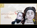 Getting rhinoplasty in korea  seoul guide medical  nosefillers nosesurgery