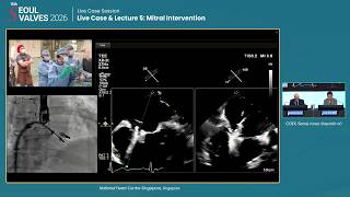[SEOUL VALVES 2026] Live Case Session - Live Case & Lecture 5: Mitral Intervention