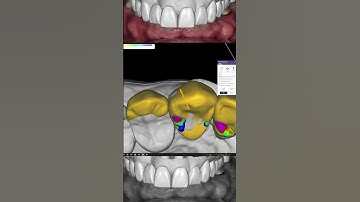 Smile Enhancement UNIMDENT CAD CAM#exocad #exocadexpert #cadcamdentistry #dental #dentalcad #dentist