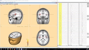 Bayesian Source Imaging with SESAME