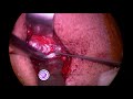 Preserving non recurrent laryngeal nerve  anatomical variation  in vns surgery  sait ozturk md