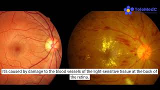 Diabetic Retinopathy Education