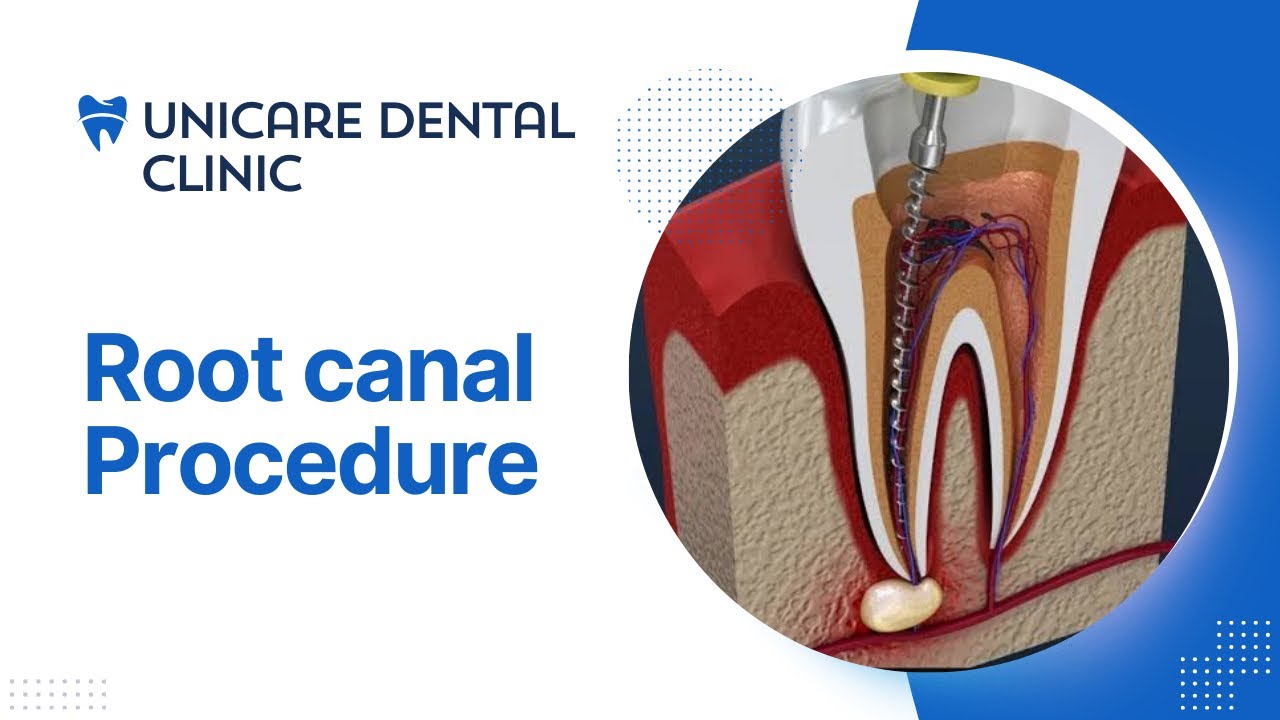 Root canal procedure step by step | 3D root canal procedure