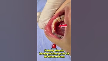 Thấy Răng Mọc Trồi Lên? Đưa Trẻ Đi Khám Ngay! I Bác sĩ Nguyễn Đình Dương
