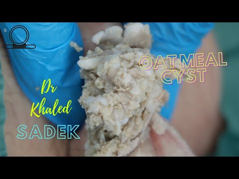 Massive Cyst Removal.Dr Khaled Sadek. LipomaCyst.com