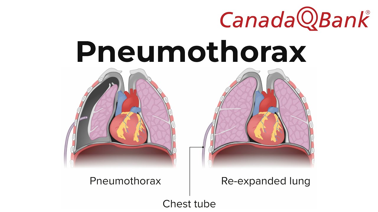 pneumothorax chest tube