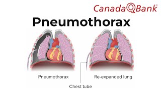 Pneumothorax