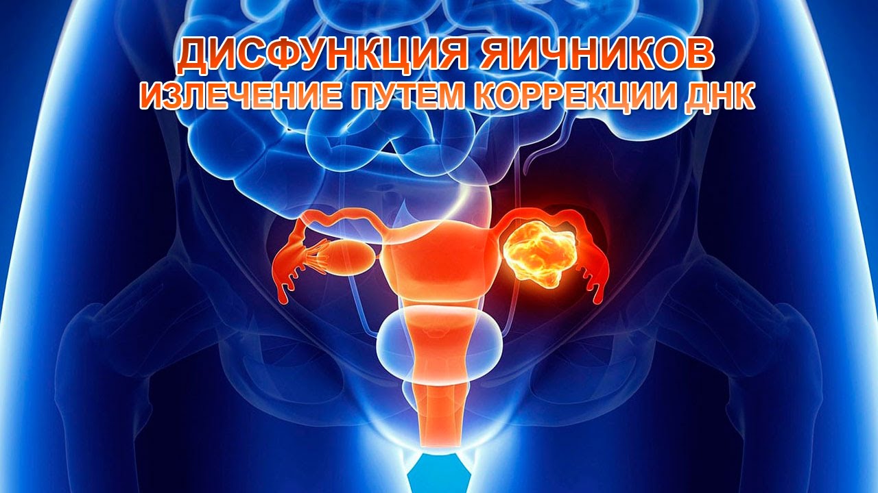 Излечение дисфункции яичников коррекцией ДНК