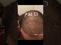 اكسبلور دويتو مراحل نمو الشعر بعد عملية زراعة الشعر من قبل العمليه لمدة 14شهر 