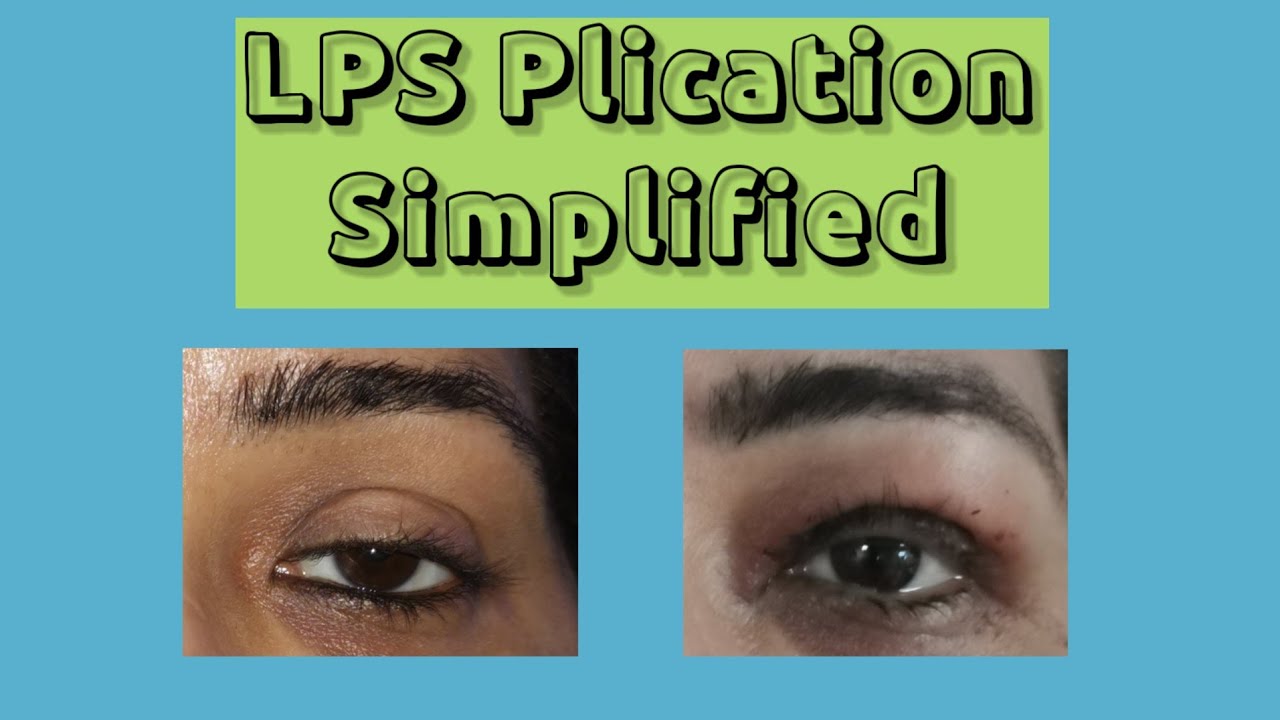 LPS plication for Aponeurotic ptosis - YouTube