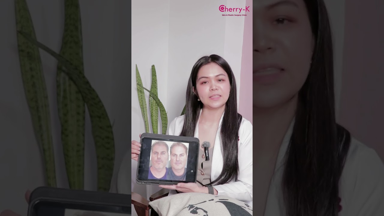 မျက်နှာသေးလေပိုငယ်လေ..🫢❤️ #youtube #cherryk #beauty #botox #hifu #vshape #mesofat #အဆီဖျော်ဆေး