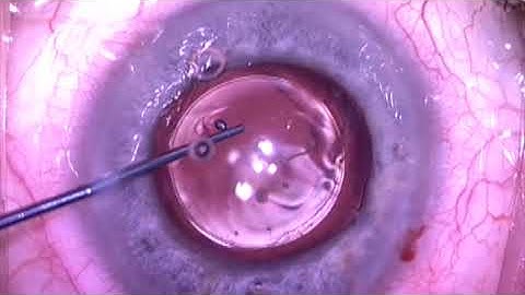 IOL reposition and then exchange by Steven G. Safran MD