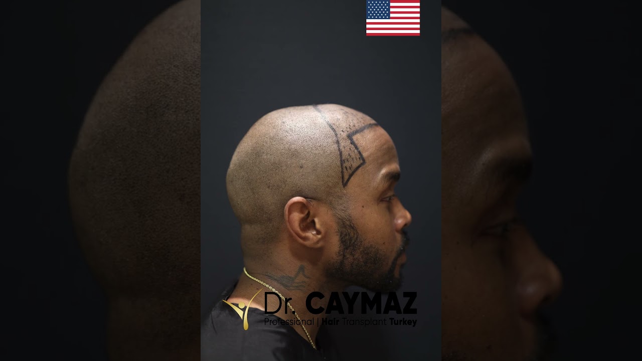 3200 Graft   6 Months Afro Result