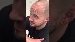 Men in their 30s|Perfect Hairline Design|Real Scalp Micropigmentation results #hairlosssolution