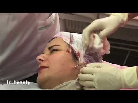 👋Процедура SMAS -ThreadLift 👋 👋Процедура SMAS -ThreadLift 👋