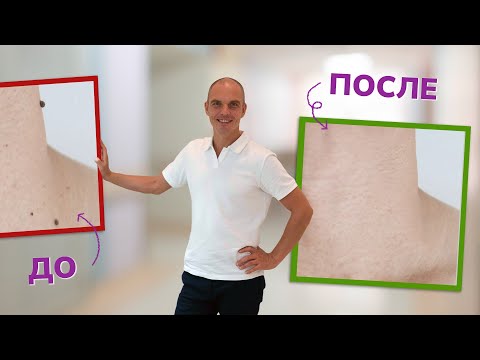 Папилломы и бородавки: Грибковая буря внутри нас и крик о помощи организма! Как от них избавиться