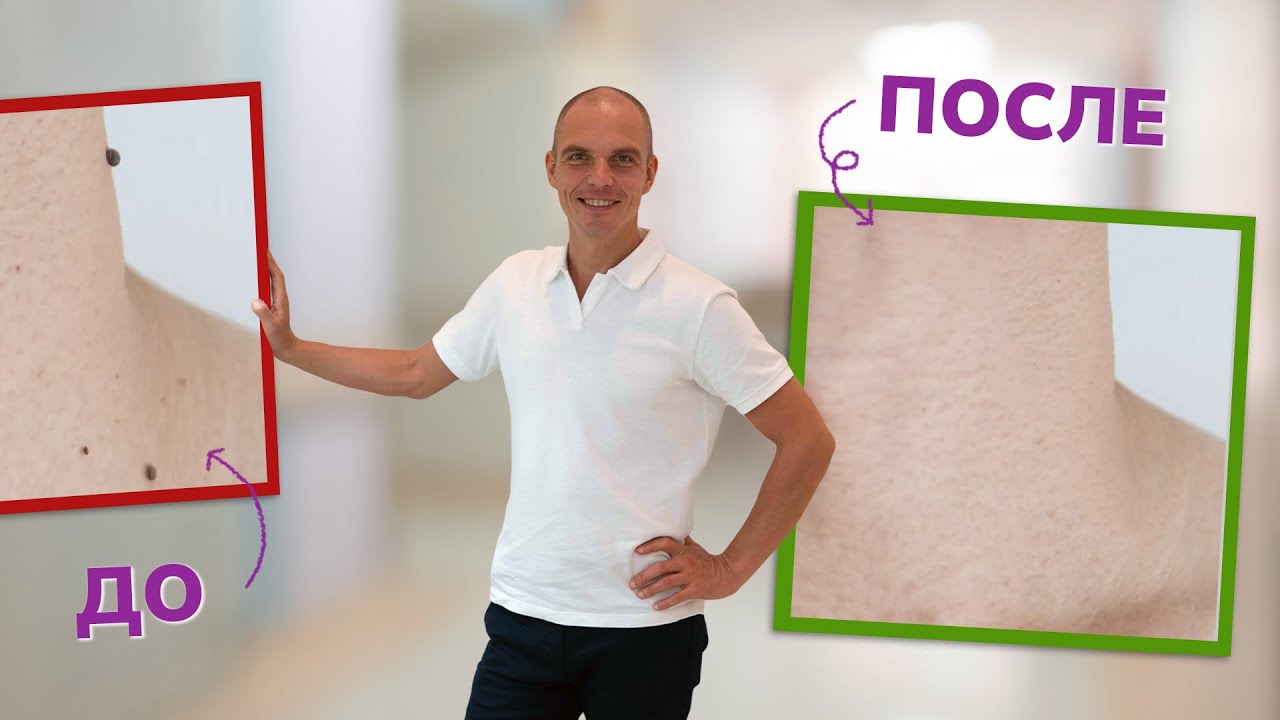 Папилломы и бородавки: Грибковая буря внутри нас и крик о помощи ...